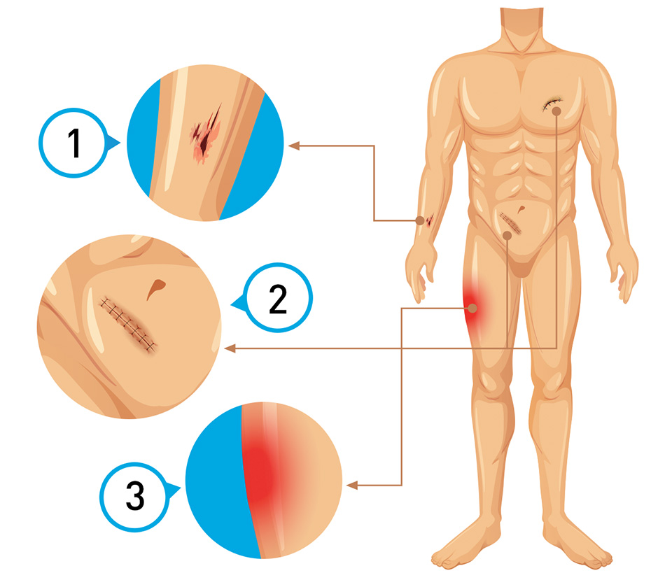 Yara Bakım Endikasyonları