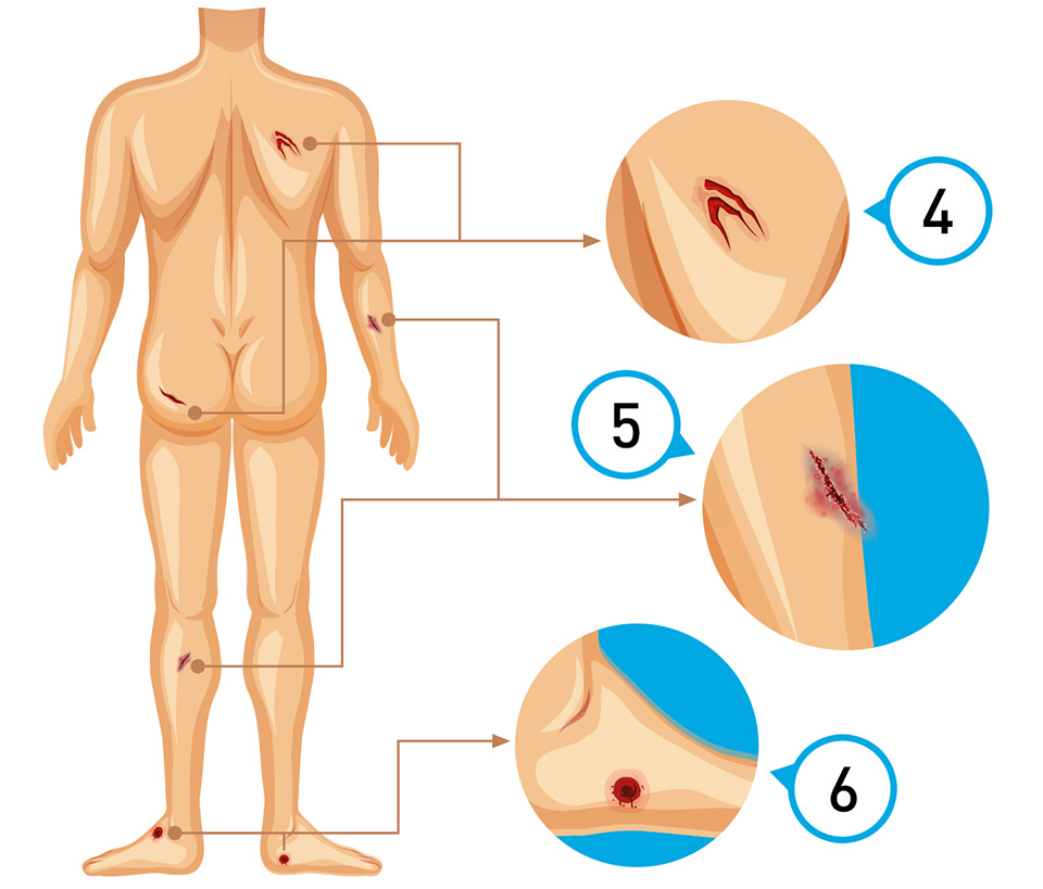 Yara Bakım Endikasyonları